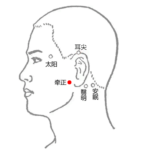 牵正